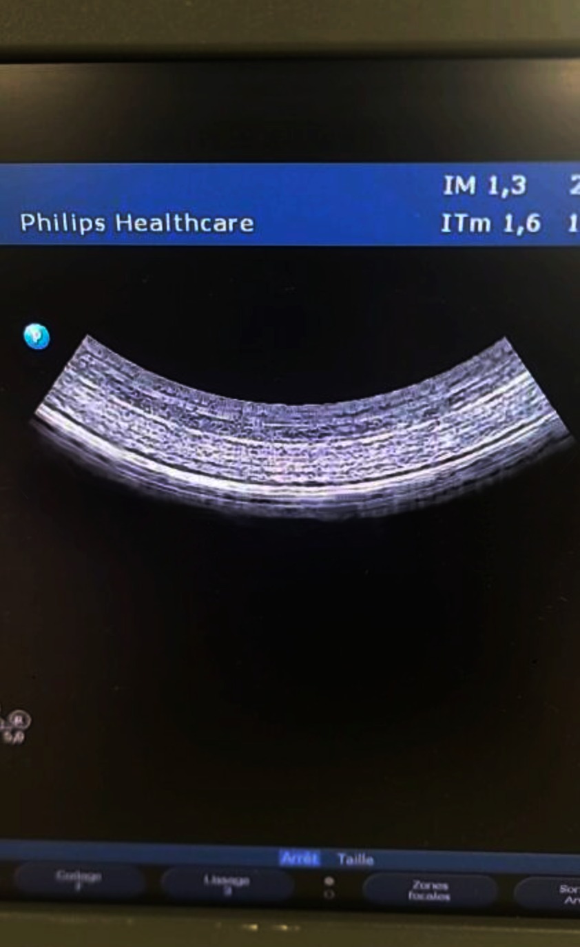 Philips C5-2 Cartridge HD11 - Imagen 5